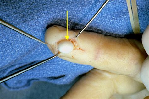 EPIDERMOID CYST Hand Surgery Resource