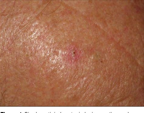 Figure 1 From Progression Of Actinic Keratosis To Squamous Cell