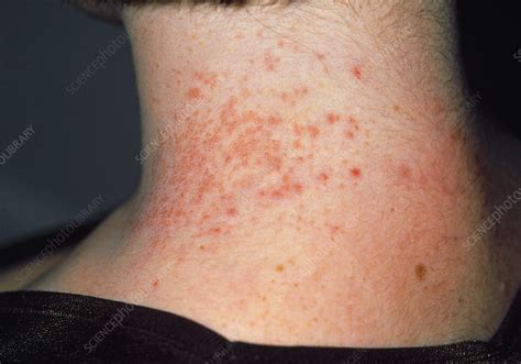 Contact Dermatitis Caused By Necklace Stock Image M3200245 Science