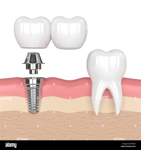 3d Render Of Implant With Dental Cantilever Bridge And Healthy Tooth In