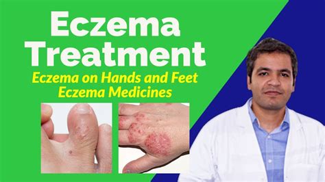 Eczema Atopic Dermatitis Causes Treatment Prevention And Home