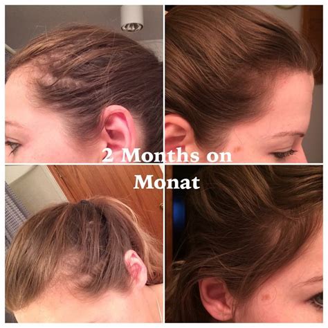 Before And After Pcos Hair Loss Hair Loss