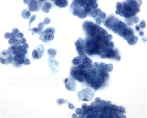 Ductal Carcinoma Breast Cytology