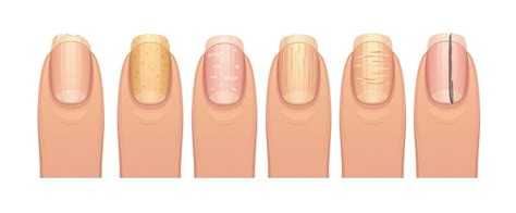 What Your Fingernails Say About Your Health Whats Good By V