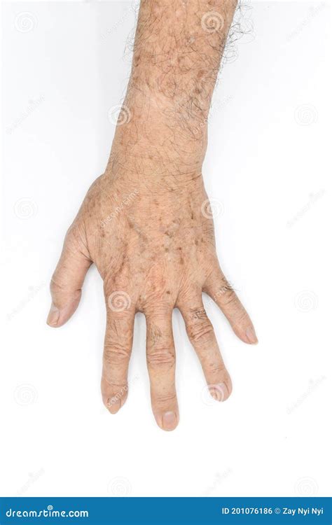 Age Spots On Hand Of Asian Elder Man They Are Brown Gray Or Black