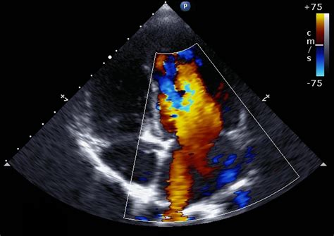 Echo Ai Detects More Aortic Stenosis The Imaging Wire
