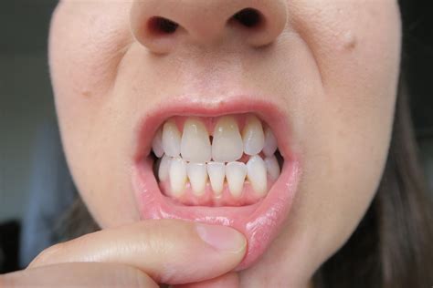 Advice Needed Im 31 With Gum Recession Despite Having No Plaque
