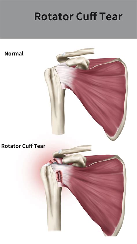 Exercise For Supraspinatus Tear Sales Cheapest Save Jlcatj Gob Mx