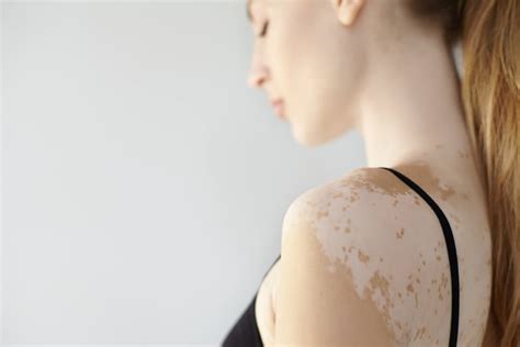 Vitiligo O Que é Causas E Tratamento Sérgio Franco