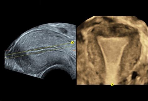 In obstetric ultrasound scans, landmarks at the anterior and posterior end of the fetal head are considered. How 3D Ultrasound Imaging Improvements Enhance Patient ...