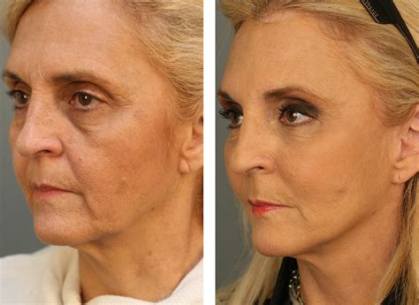 Methods To Conduct Your Own Home Based Facelift Employing Face Training