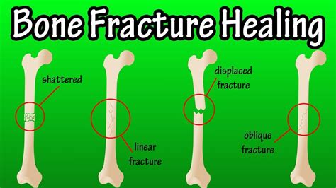 How Does A Bone Break Heal Bone Fracture Healing Process Youtube