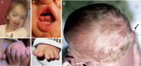 The Molecular Genetics Of Joubert Syndrome And Related Ciliopathies