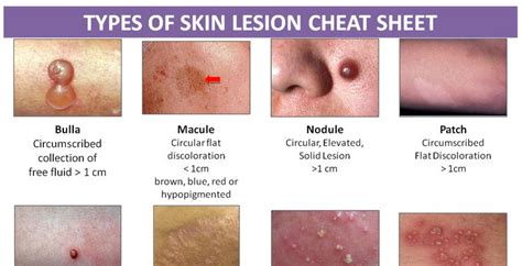 Skin Lesion Cheat Sheet