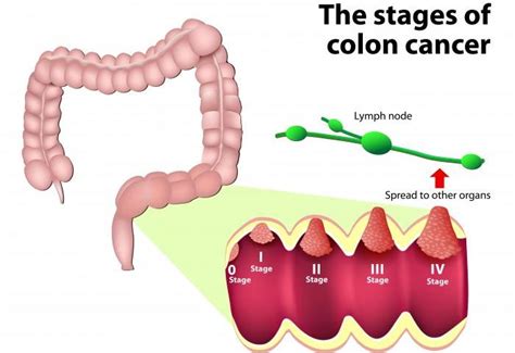 It is also the second leading cause of cancer deaths. Colon Cancer Treatment in USA, UK & UAE | Easy 3 day cleanse