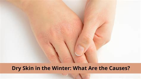 Dry Skin In The Winter Causes Symptoms Risk Factors And Home Remedies