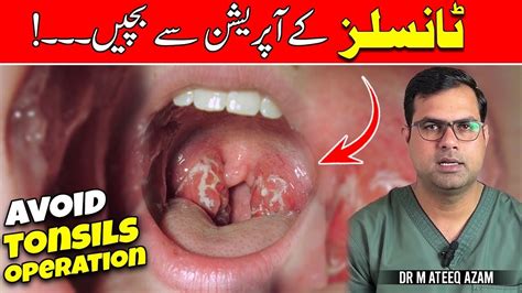 The 1 Best Method To Treat Tonsillitis Youtube