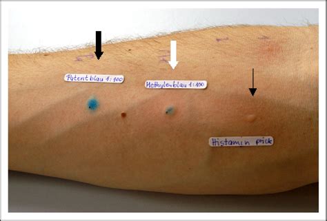 Hypersensitivity Reaction Against Patent Blue During Sentinel Lymph
