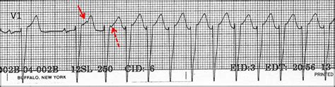 Intermittent short ecg recording over a longer time period might be a convenient and more sensitive intermittent short ecg recording during four weeks is more effective in detecting af and psvt in. Psvt Ecg / Supraventricular Tachycardia Wikivisually ...