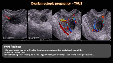 Ovarian Ectopic Pregnancy Ultrasound