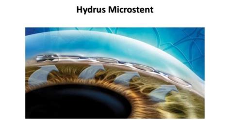 Hydrus Microstent For Glaucoma Glaucoma Treatment Intraocular Pressure