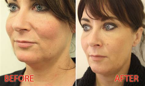 Pdo Thread Lift Jawline Before And After Before And After