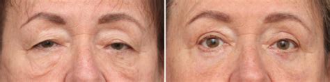 Lower Eyelid Surgery Before And After Photos Nicole Schrader Md Facs