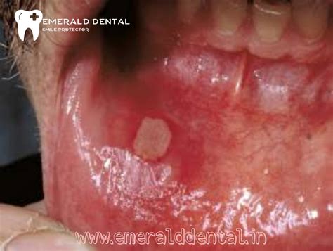 What Is An Aphthous Ulcer Emerald Dental