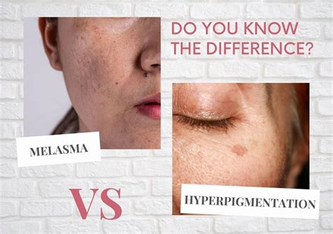 The Different Between Melasma And Hyperpigmentation Justinboey