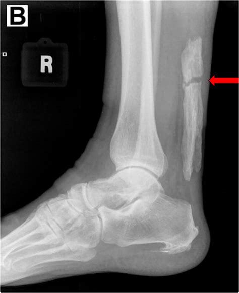Acute Fracture Of Extensive Achilles Tendon Calcific Tendinopathy