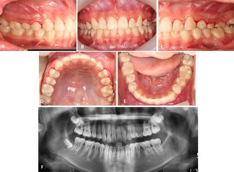 Treatment Of 2 Impacted Molars In A Large Dentigerous Cyst Expansile