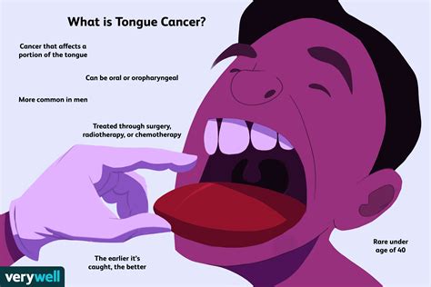 Tongue Cancer Symptoms Causes Treatment Prevention The Best Porn Website