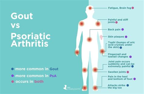 Gout Vs Psoriatic Arthritis Differences In Symptoms And Treatments
