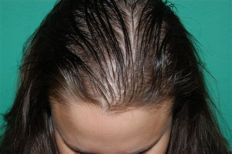 Hair Loss Treatment For Women Chicago Il Chicago Hair Institute