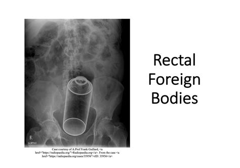 Emergency Medicine Educationrectal Foreign Bodies Not Always A Simple Ed Diagnosis