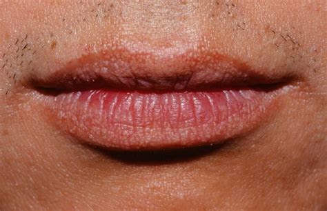 11 Tips To Prevent And Treat Fordyce Spots On Lips Instiks