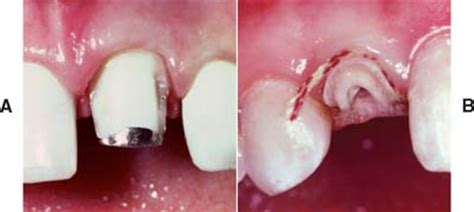 Before installing permanent crowns, a dentist will prep since the temporary crowns will only need to last for a few weeks each patient's individual scenario, along with the type of dental crown, will dictate how much of the tooth structure needs to be. 12: RESTORATION OF THE ENDODONTICALLY TREATED TOOTH ...