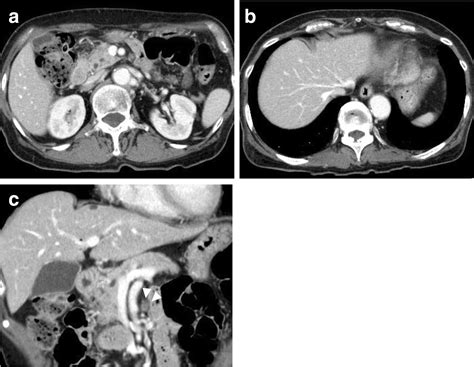 Conversion Surgery For Initially Unresectable Carcinoma Of The Ampulla