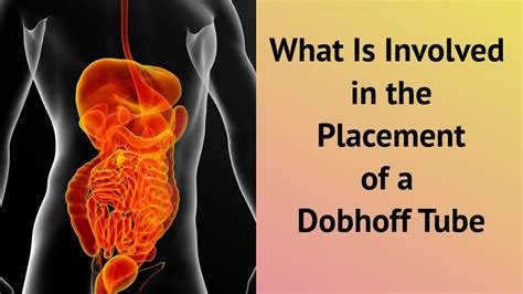 What Is Involved In The Placement Of A Dobhoff Tube Youtube