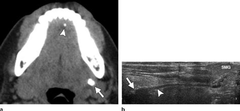 Submandibular Duct Obstruction By Calculi A Unenhanced Axial Ct