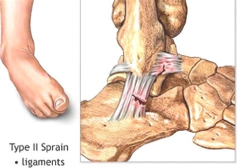 Torn Ankle Ligament Esh Nanoori