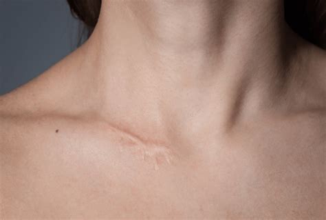 Laser Treatment For Scars Everything You Need To Know Lynton Lasers