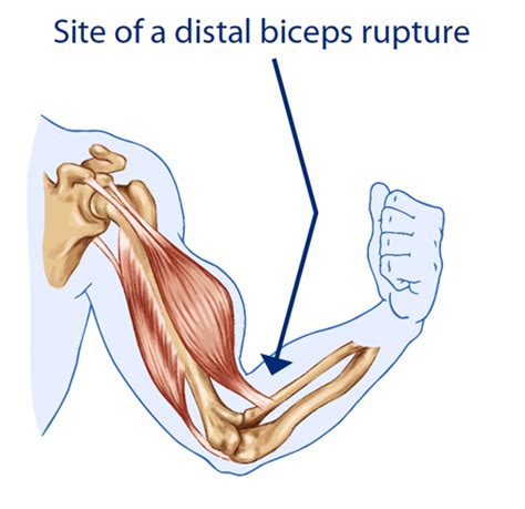 Distal Biceps Rupture Bouldercentre For Orthopedics And Spine