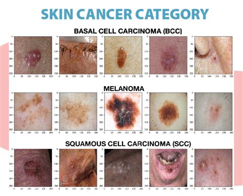 Skin Cancer Symptoms Causes Diagnosis Treatment Medtalks