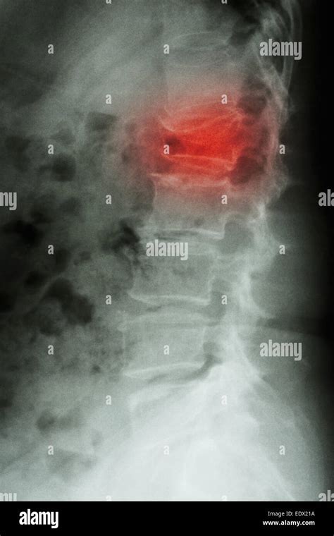 Film X Ray Lumbar Spine Lateral Show Burst Fracture At Lumbar Spine Collapse At Body Of