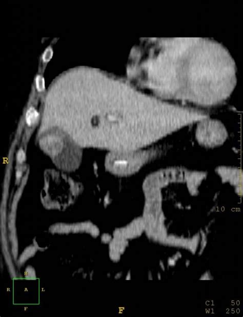 Adenosquamous Carcinoma Of The Gallbladder Eurorad