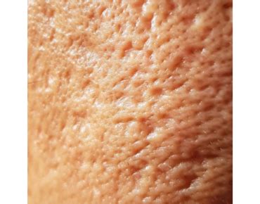 Cicatrici De Acnee Clasificare Si Optiuni De Tratament Skin Clinic