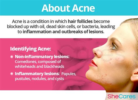 What Is Acne Acne Acne Causes Inflammation Causes