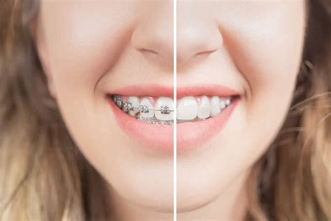 Before And After Braces Orthodontic Services Johns Creek Ga