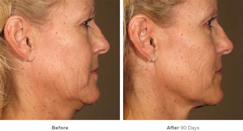 The Authentic Non Invasive Ultrasound Lift Skin Tightening Ultherapy